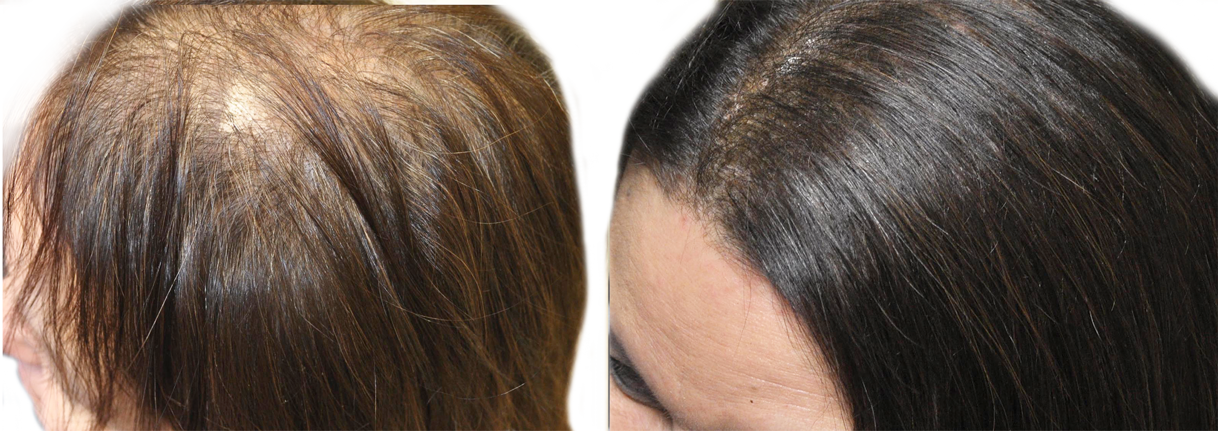 Long Island hair rejuvenation before and after