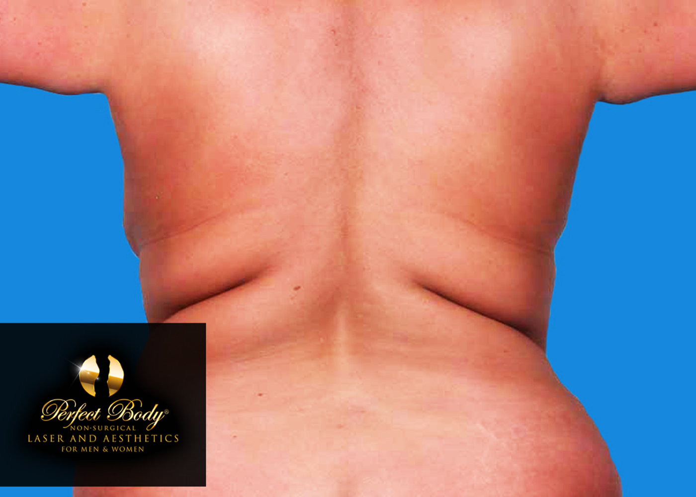 CoolSculpting laser fat removal for a Perfect Body!