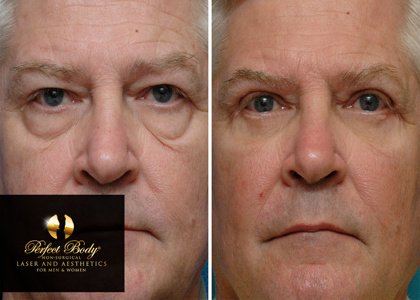 Ultherapy Laser Skin Tightening For The Face
