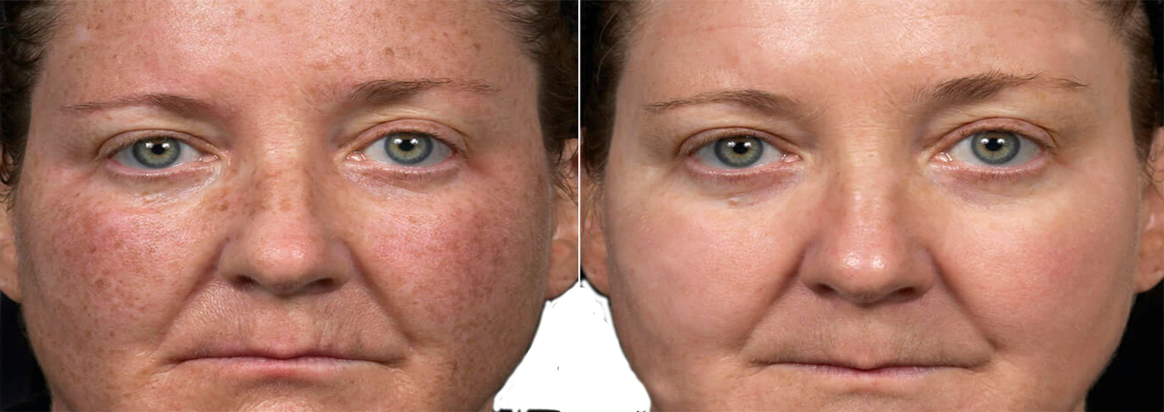 Long Island color correction and skin rejuvenation before after
