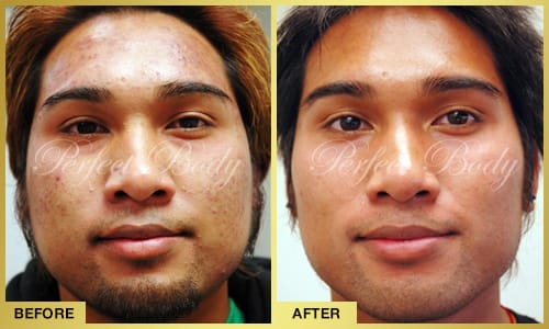 Acne & Scar Removal