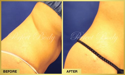 Body Reshaping & Contouring
