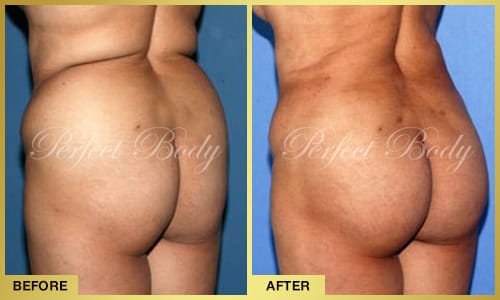 Body Reshaping & Contouring
