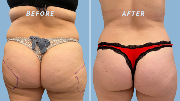 CoolSculpting body contouring result