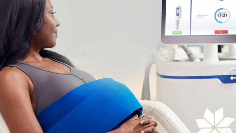 CoolSculpting fat reduction result