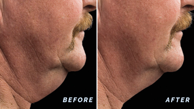 CoolSculpting treatment result