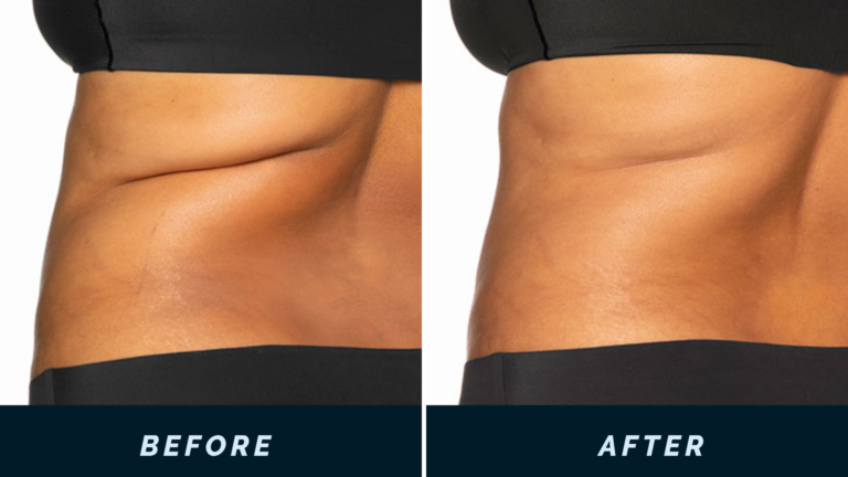CoolSculpting fat freezing result
