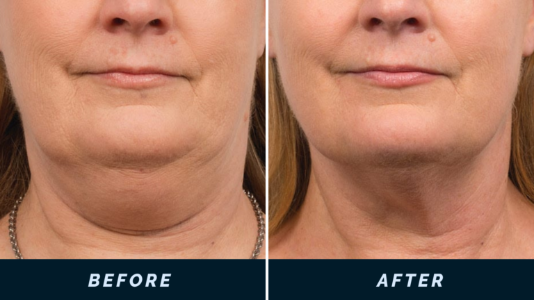 CoolSculpting before and after photo