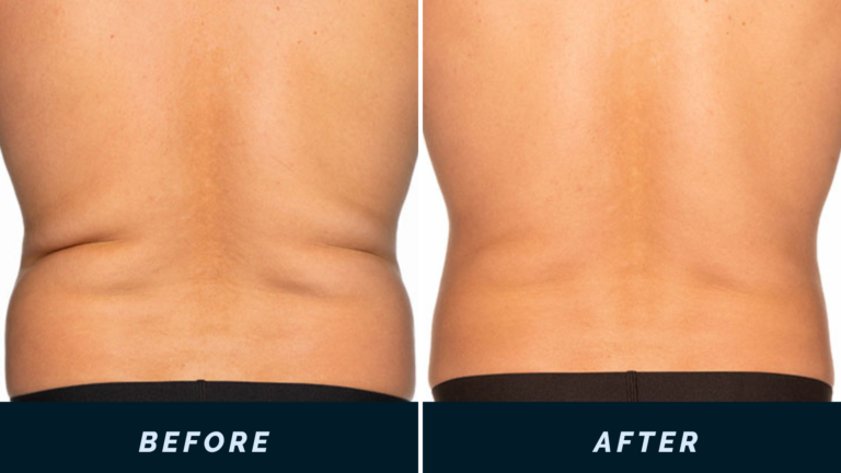 CoolSculpting treatment photo