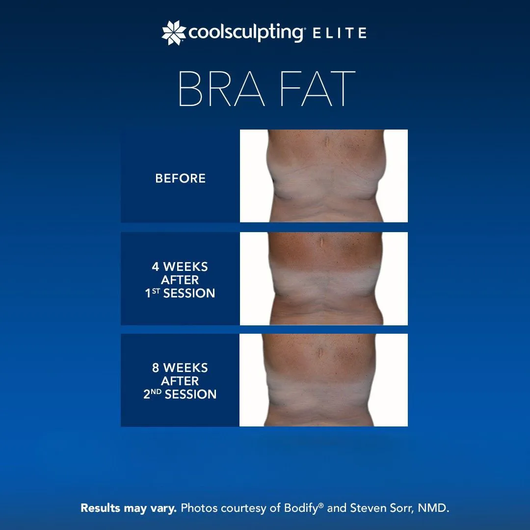 CoolSculpting bra fat reduction Long Island