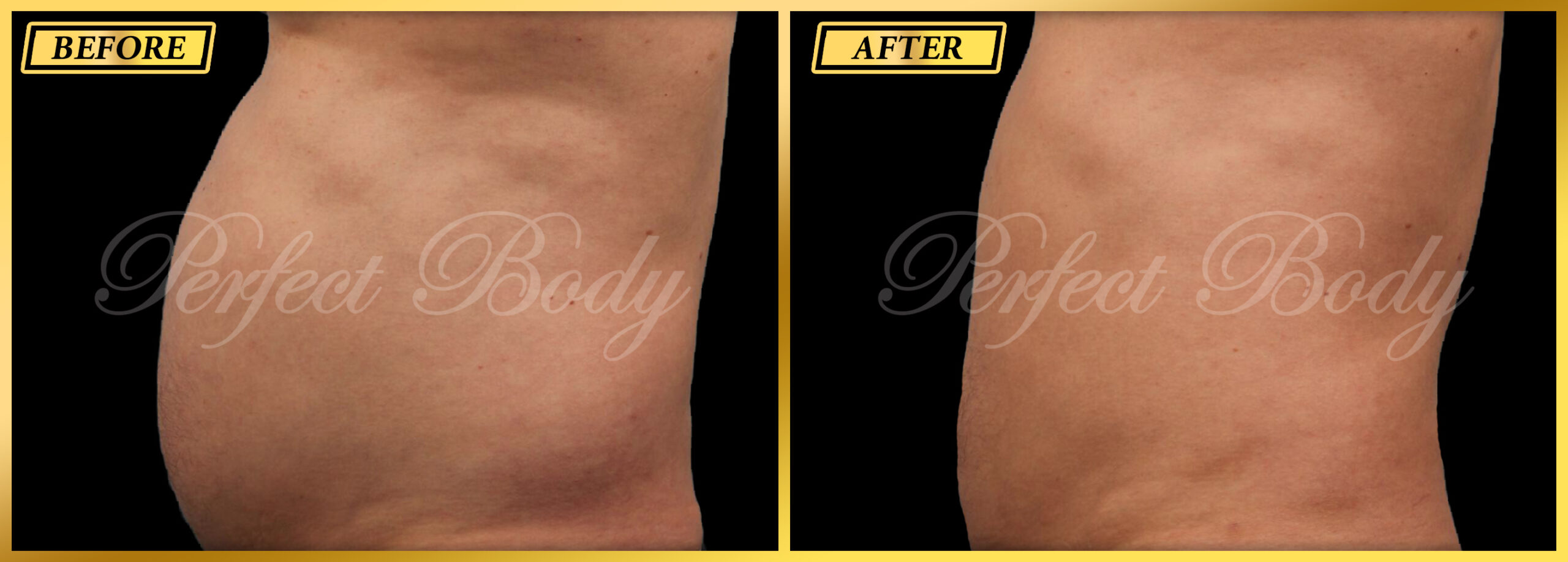 Fat Reduction Result 1