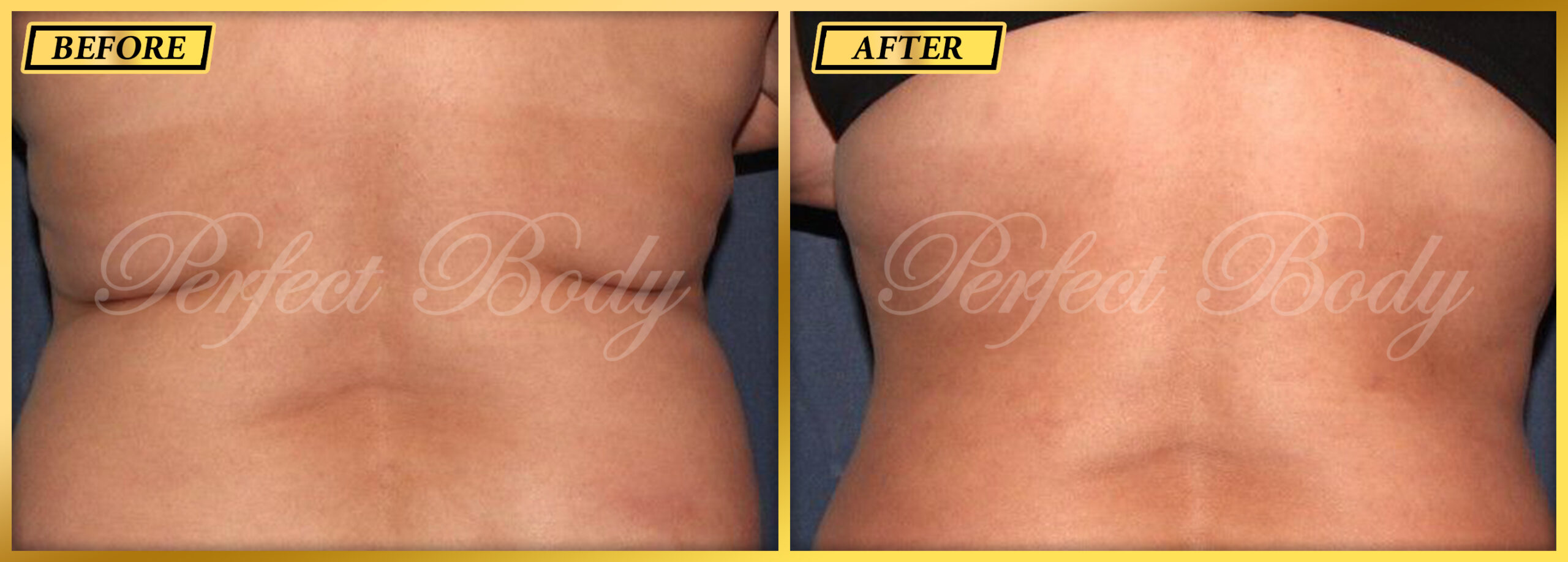 Fat Reduction Result 3