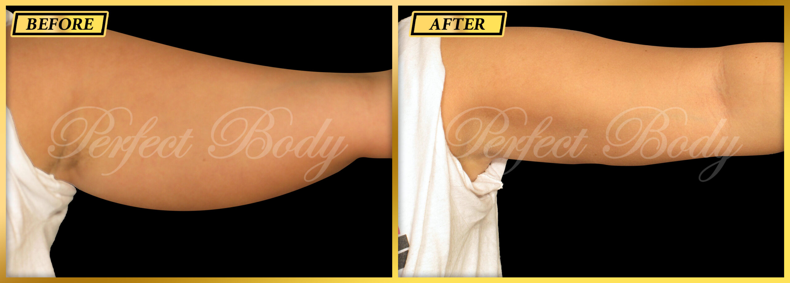 Fat Reduction Result 4