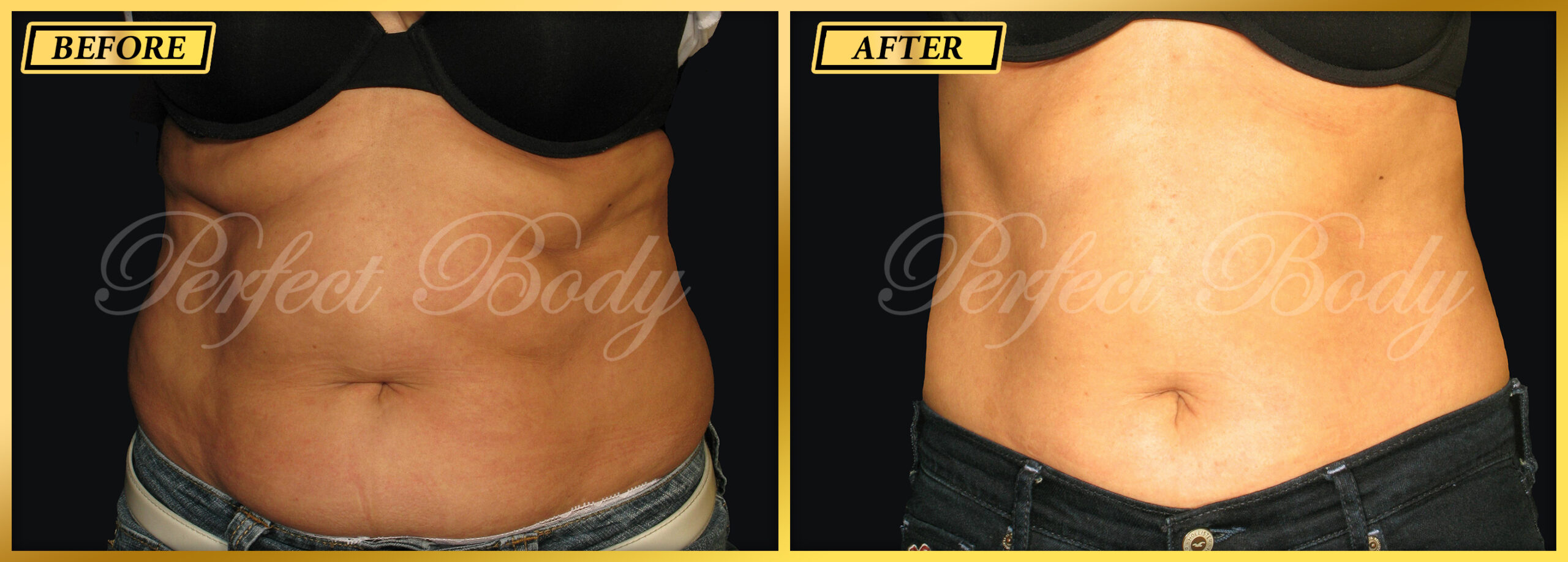 Fat Reduction Result 6