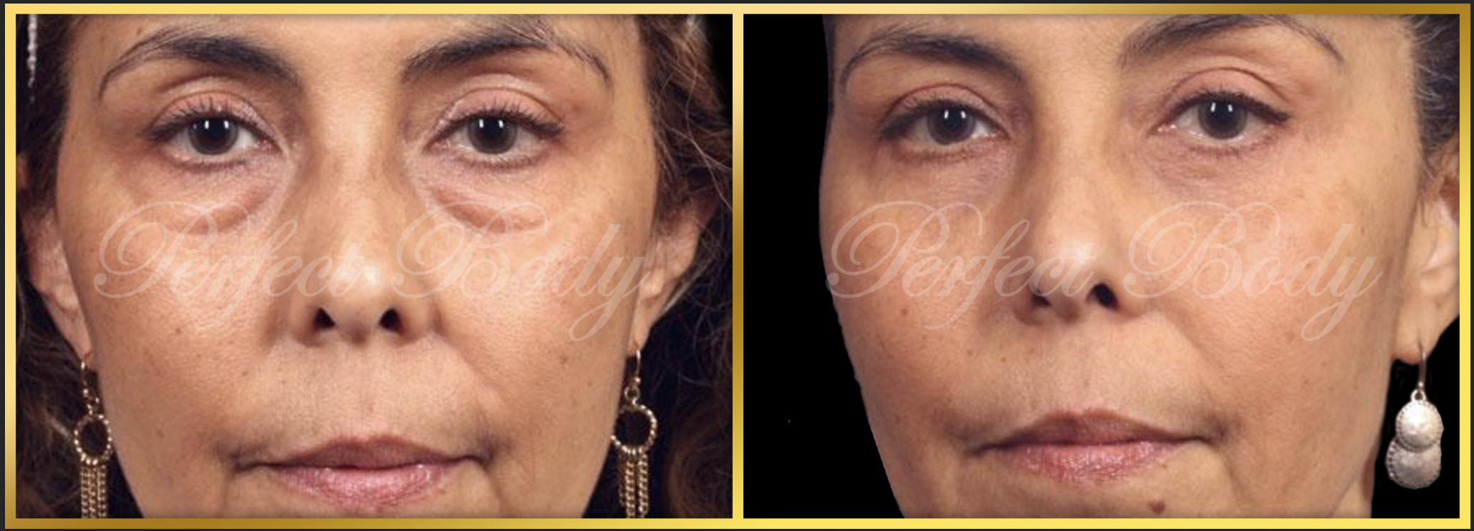 Eyelid lift before and after - Patient 4