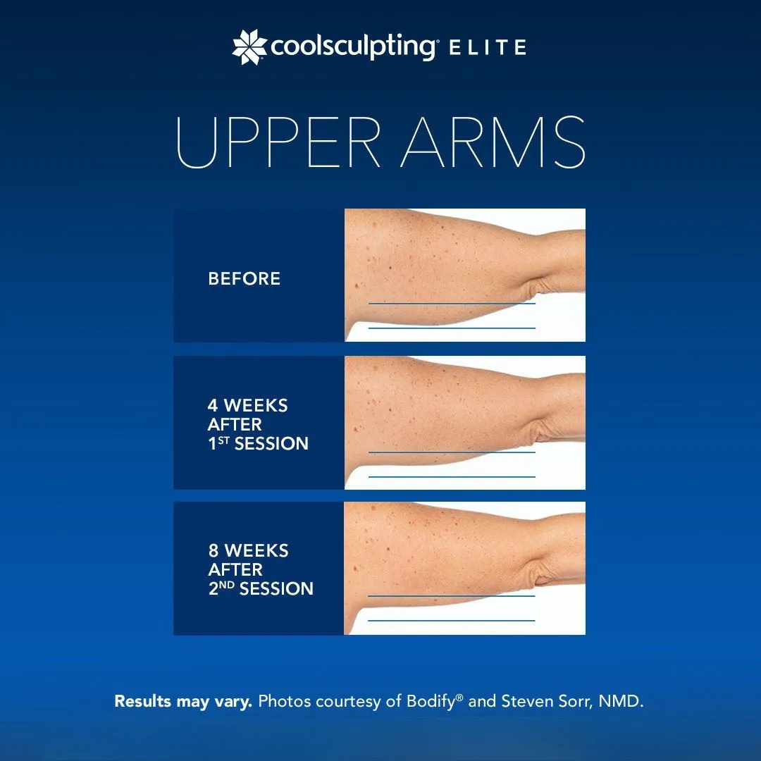 CoolSculpting upper arms fat reduction Long Island