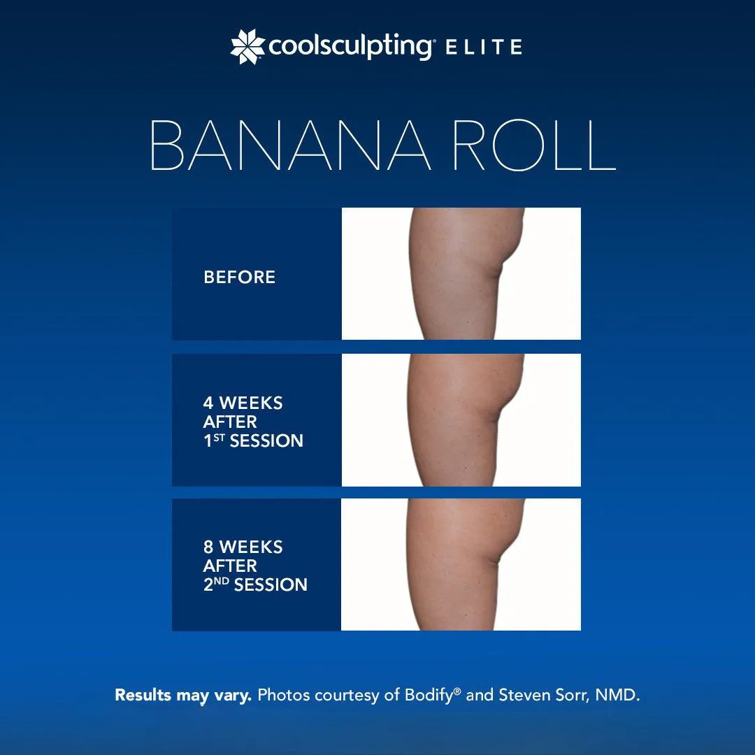 CoolSculpting banana roll fat reduction Long Island