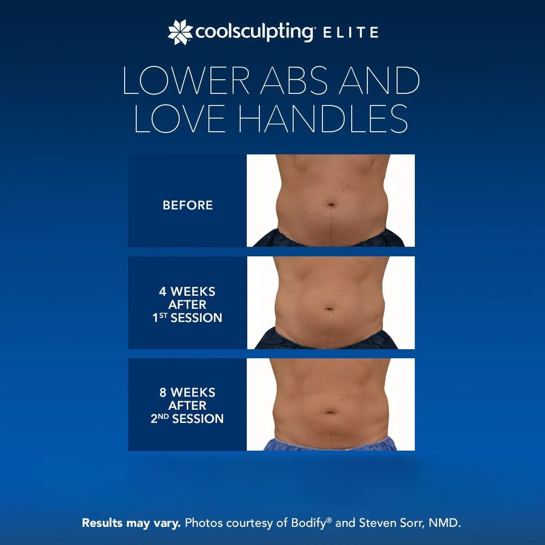 CoolSculpting lower abs and love handles fat reduction Long Island