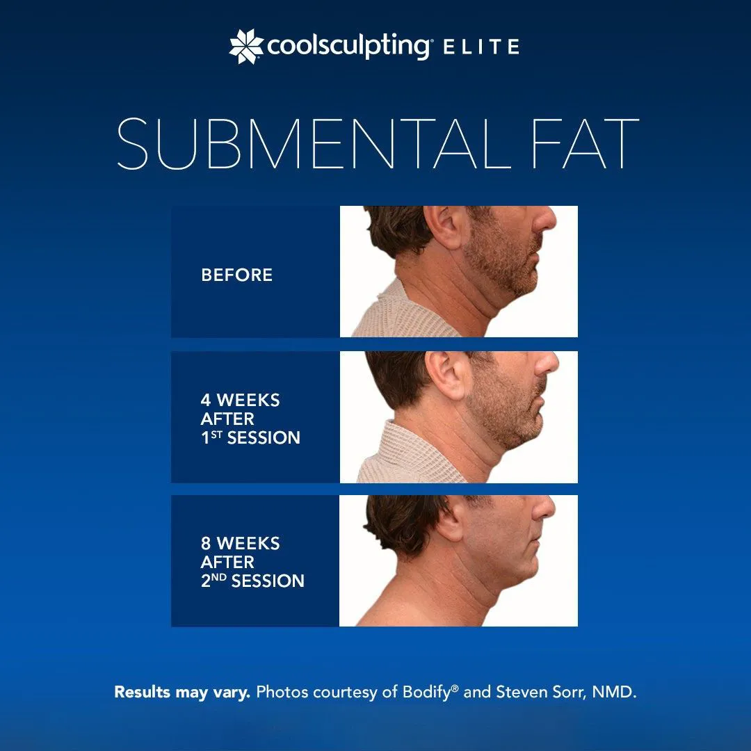 CoolSculpting submental double chin fat reduction Long Island