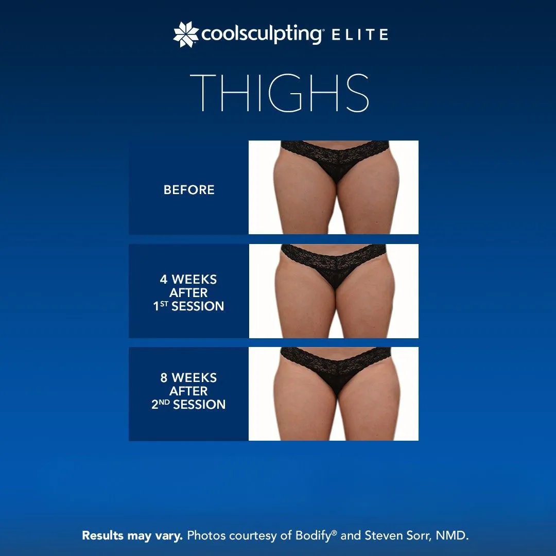 CoolSculpting thighs fat reduction Long Island