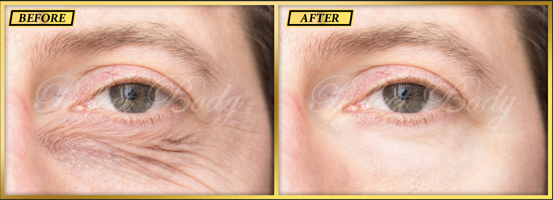 Non-surgical eyelid lift before and after results at Perfect Body Laser Long Island
