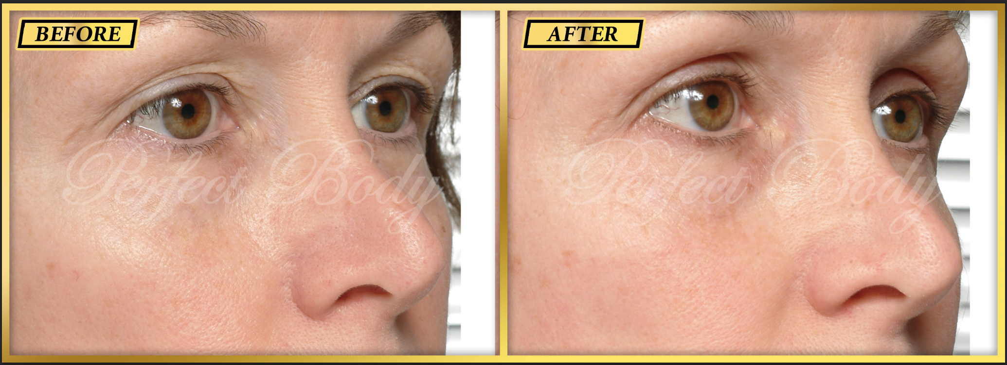 Eyelid lift before and after - Patient 3