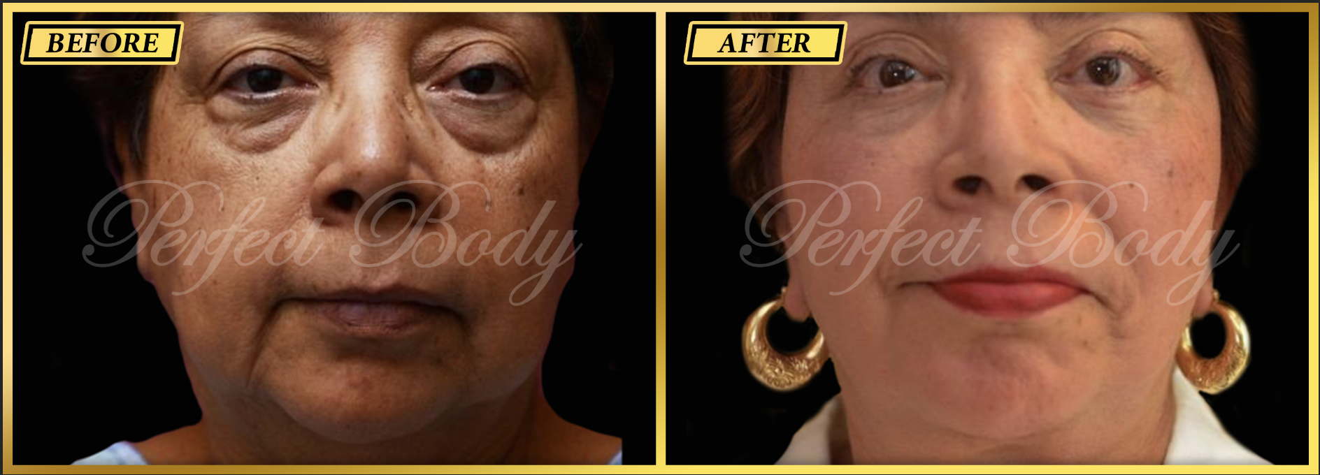 Eyelid lift before and after - Patient 1