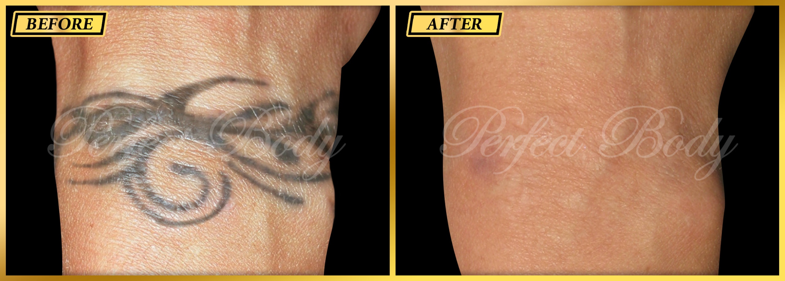 Tattoo removal before and after results at Perfect Body Laser Long Island