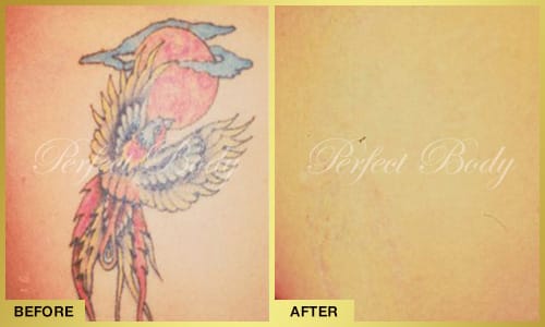 Picosecond laser tattoo removal - wrist tattoo removal results