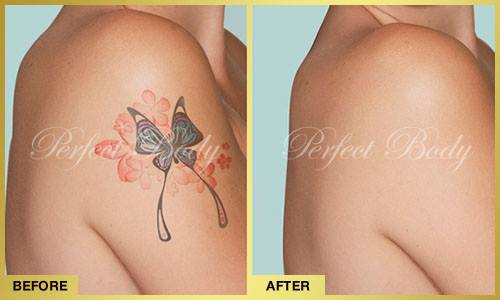 Complete tattoo removal results at Perfect Body Laser Bay Shore