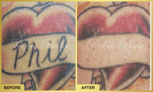Professional laser tattoo removal - name tattoo removal Long Island