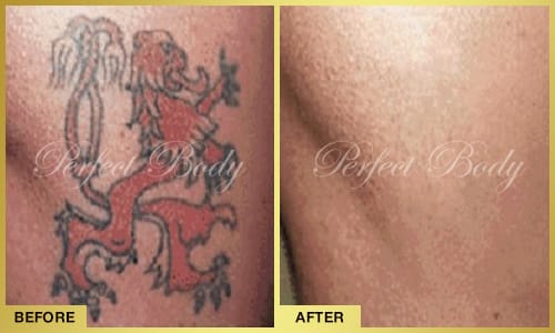 Tattoo removal before and after - arm tattoo removal Long Island