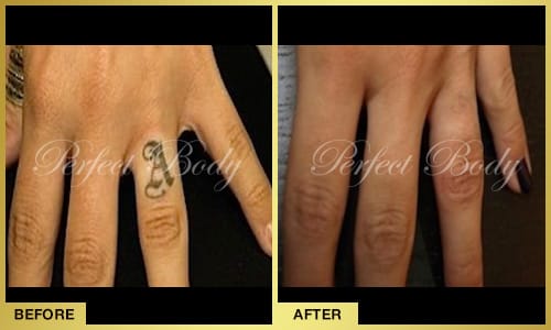 Laser tattoo removal results - colored tattoo removal Long Island