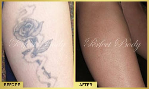 Before and after tattoo removal - hand tattoo removal Bay Shore NY