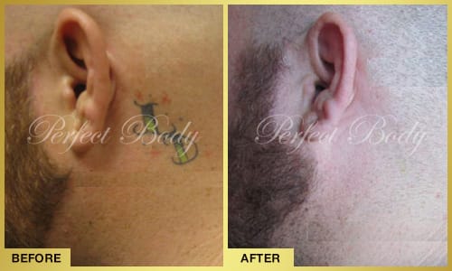 Tattoo removal progress photos - back tattoo removal Long Island