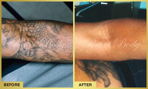 Successful tattoo removal before and after - Perfect Body Laser