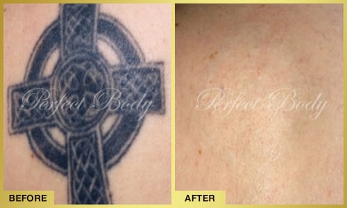 Advanced laser tattoo removal results - shoulder tattoo removal