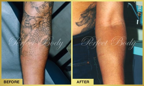 Laser tattoo removal before and after - leg tattoo removal
