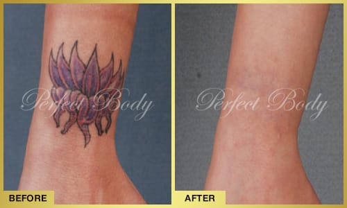 Tattoo removal session results - multi-color tattoo removal